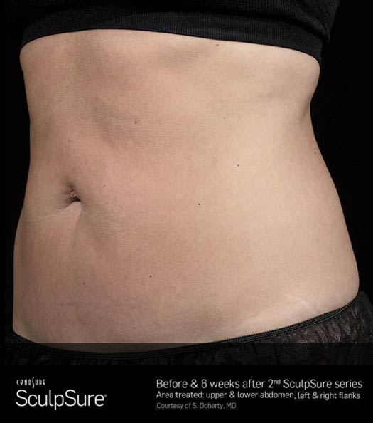 Sculpsure Before & After Image