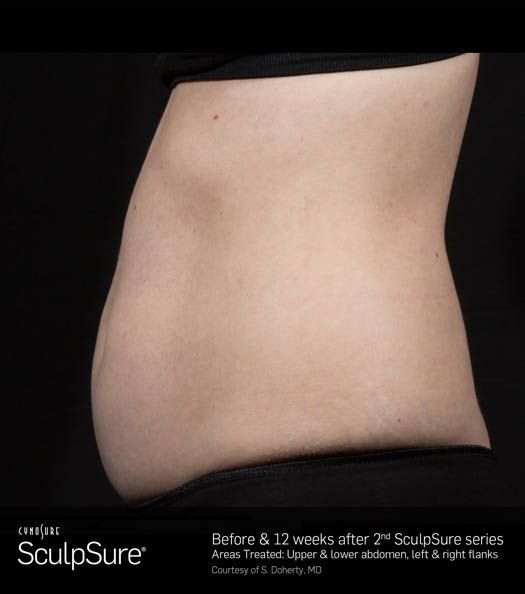 Sculpsure Before & After Image