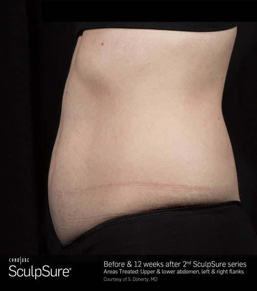 Sculpsure Before & After Image