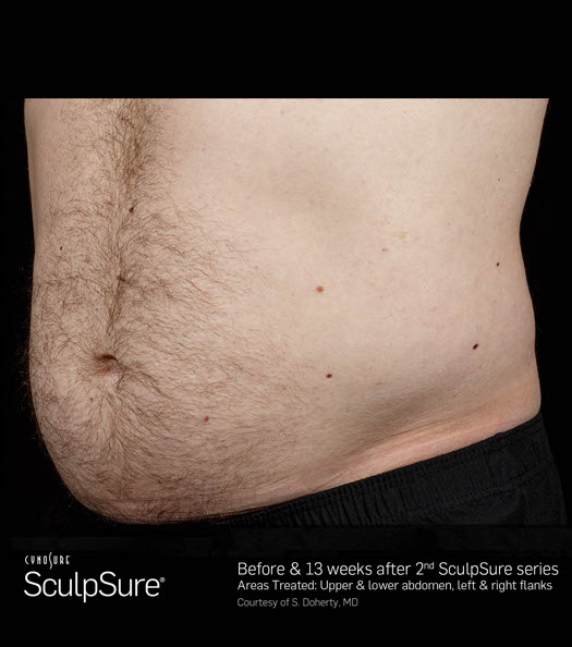 Sculpsure Before & After Image