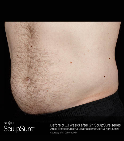 Sculpsure Before & After Image