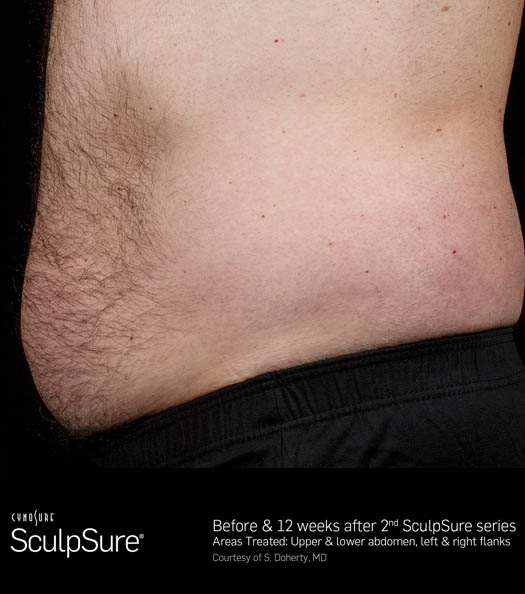 Sculpsure Before & After Image