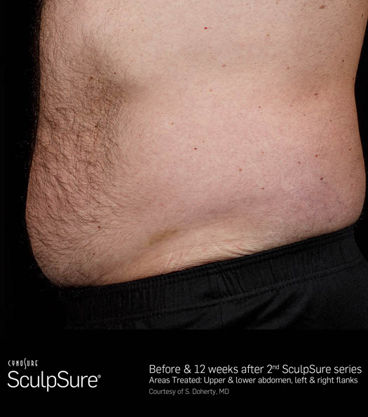 Sculpsure Before & After Image