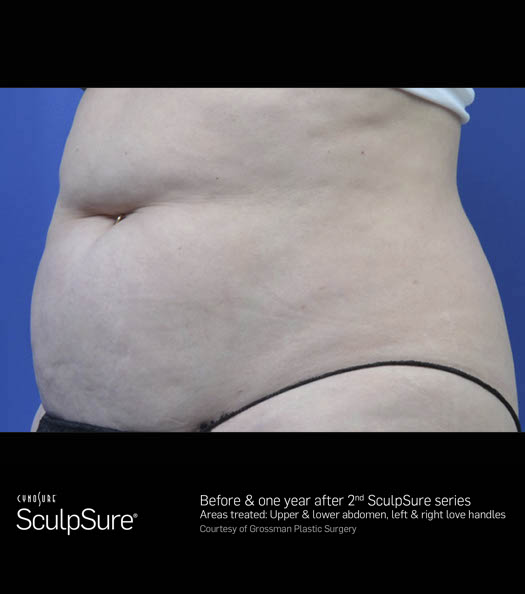 Sculpsure Before & After Image