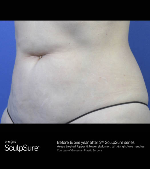 Sculpsure Before & After Image