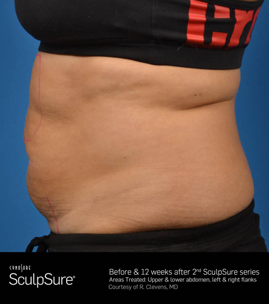 Sculpsure Before & After Image