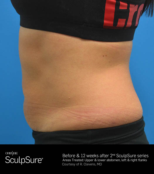 Sculpsure Before & After Image