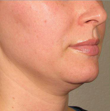 Ultherapy Before & After Image