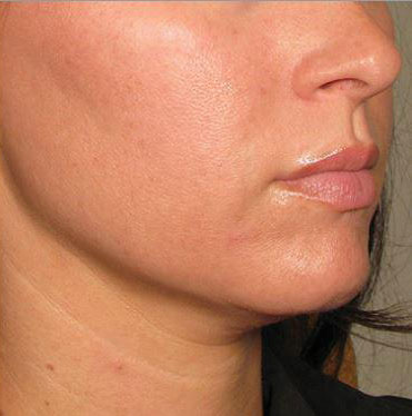 Ultherapy Before & After Image