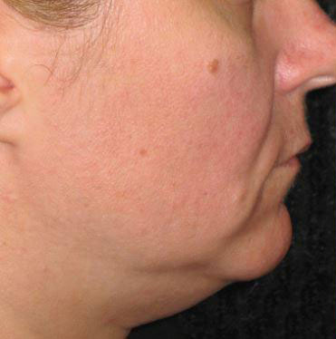 Ultherapy Before & After Image