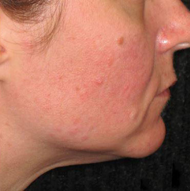 Ultherapy Before & After Image