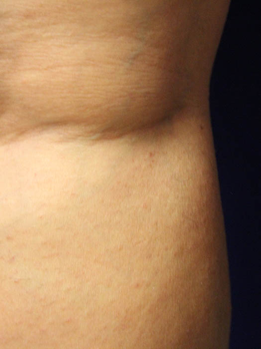 Vein Therapy Before & After Image