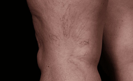 Vein Therapy Before & After Image