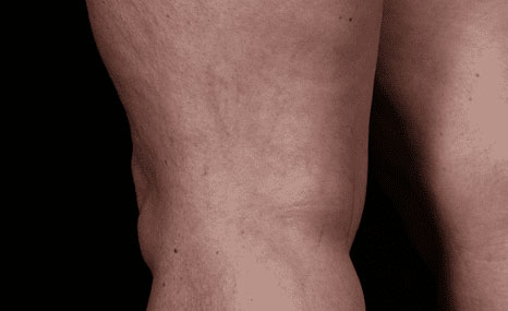 Vein Therapy Before & After Image