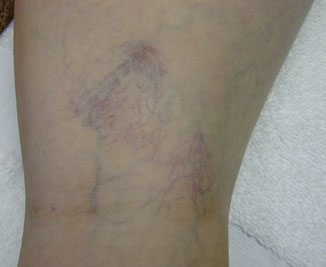 Vein Therapy Before & After Image