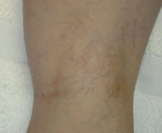 Vein Therapy Before & After Image